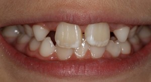 do water filters remove fluoride fluorosis of the teeth
