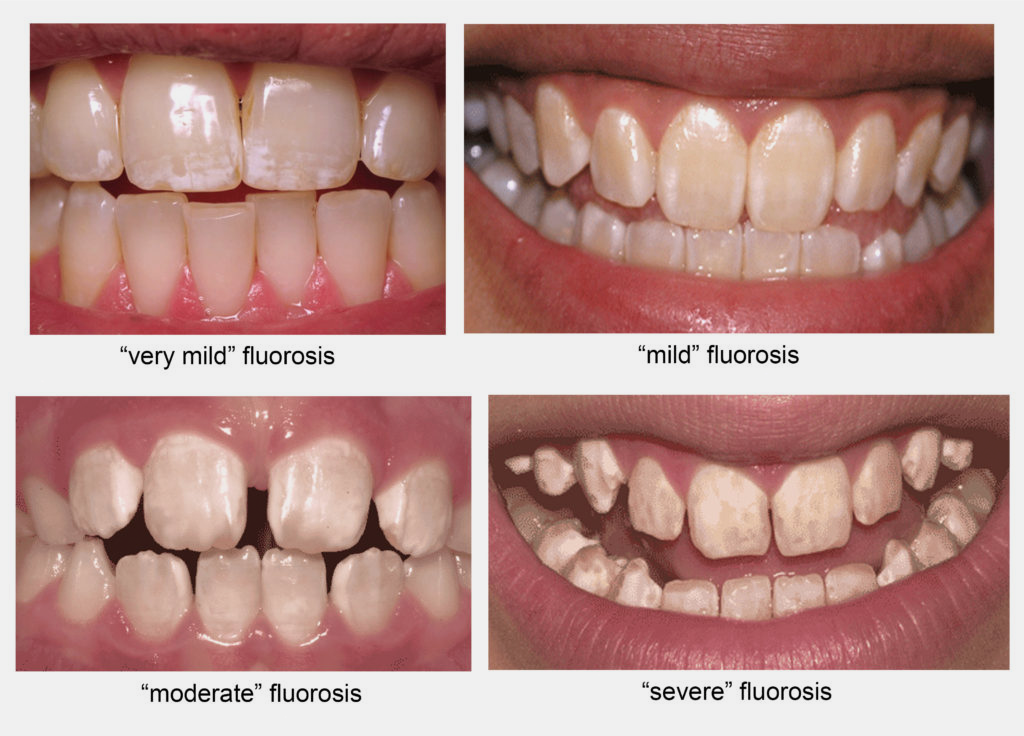 Causes Of Dental Fluorosis