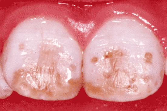 Another photograph of severe dental fluorosis